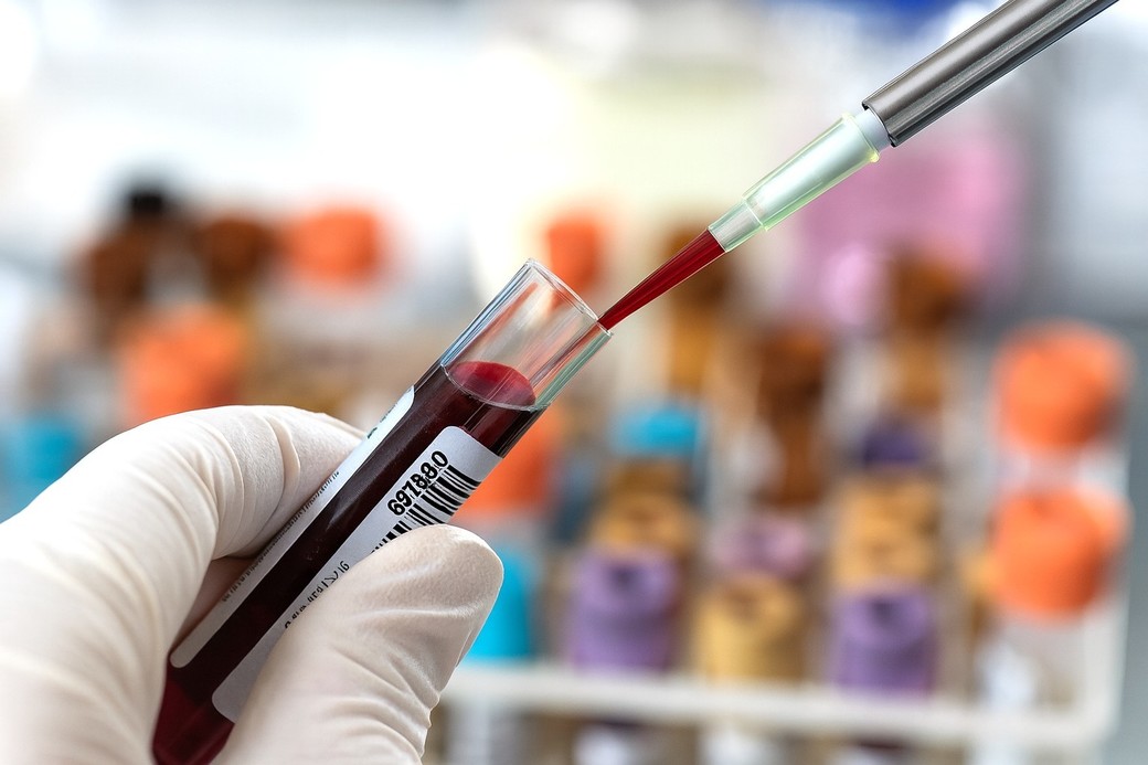 Un test de sânge analizat cu AI ar putea accelera depistarea sclerozei laterale amiotrofice