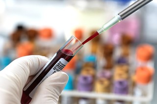 Un test de sânge analizat cu AI ar putea accelera depistarea sclerozei laterale amiotrofice