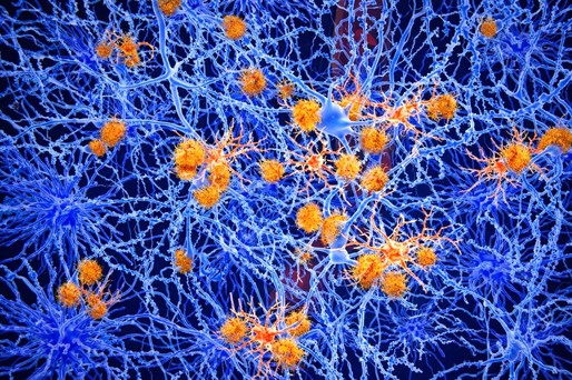 Cercetătorii au identificat o modalitate de a opri deteriorarea creierului în boala Alzheimer

