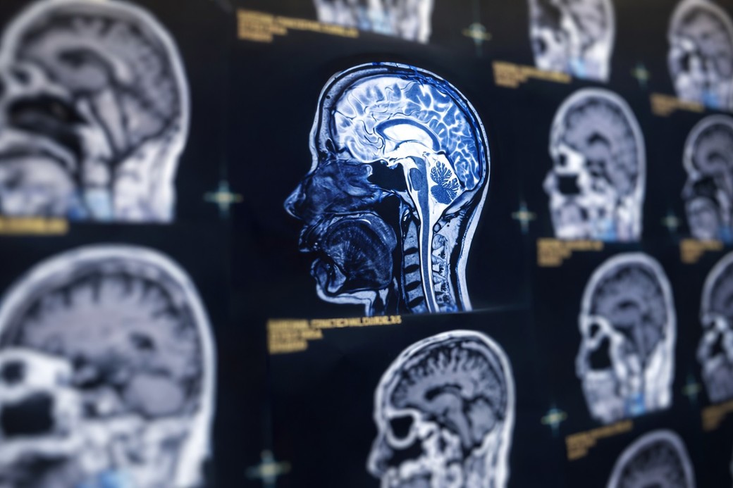 Inteligenţa artificială poate identifica boala Alzheimer cu o precizie ridicată, sugerează noi date