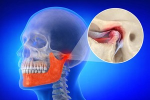 Potenţială ţintă terapeutică pentru protejarea cartilajului în artroza mandibulară