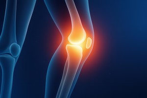 Soluţie inovatoare pentru încetinirea osteoartritei şi evitarea protezării articulare