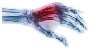 Un adeziv osos experimental promite tratarea rapidă a fracturilor