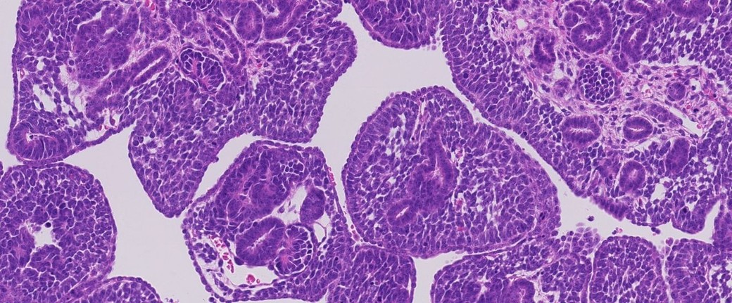 Descoperiri genetice majore în cancerul renal pediatric 