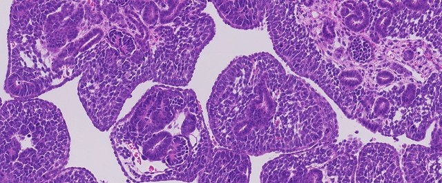 小児腎癌における主要な遺伝的発見