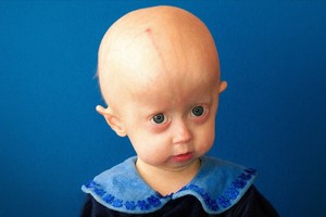 Genă descoperită la persoane longevive ar putea preveni deteriorarea inimii în cazul unei boli pediatrice rare ce provoacă îmbătrânire prematură