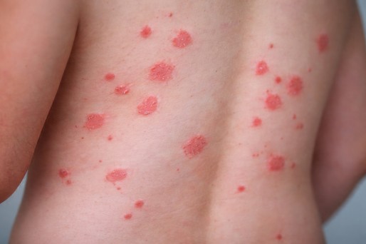 Celule imune recent identificate explică asocierea dintre infecţia streptococică faringiană şi psoriazis


