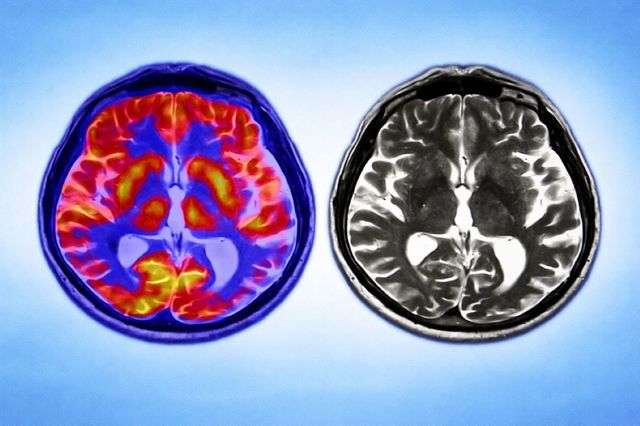 Poza pentru articolul Menopauza, legată de modificări ale structurii creierului similare celor observate în demenţă