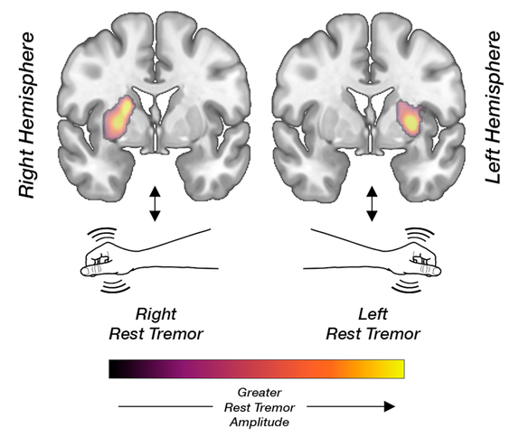 Tremorul de repaus în Parkinson ar putea avea un mecanism diferit de celelalte simptome motorii