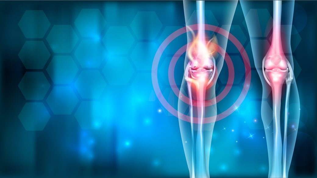 Artrita reumatoidă începe cu ani înainte de apariţia simptomelor. Ar putea fi prevenită?
