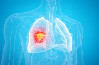 VIDEO Un algoritm de AI poate identifica tumorile pulmonare pe care chiar şi un ochi expert le poate rata