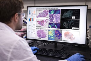 Un instrument de AI poate estima eficienţa chimioterapiei în cancerul pulmonar agresiv înainte de începerea tratamentului