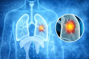 Cancerul pulmonar: vârsta influenţează creşterea tumorilor şi răspândirea în organism