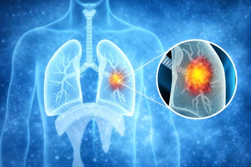 Cancerul pulmonar: vârsta influenţează creşterea tumorilor şi răspândirea în organism