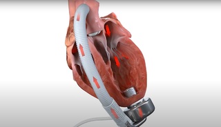 O nouă pompă cardiacă, dezvoltată în Franţa, a fost implantată cu succes la primul pacient