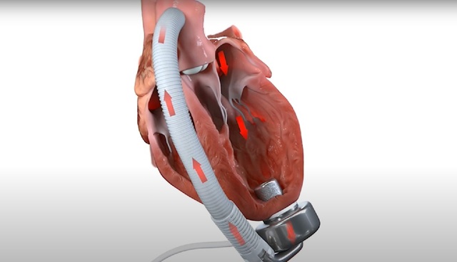 O nou&#259; pomp&#259; cardiac&#259;, dezvoltat&#259; &icirc;n Fran&#355;a, a fost implantat&#259; cu succes la primul pacient