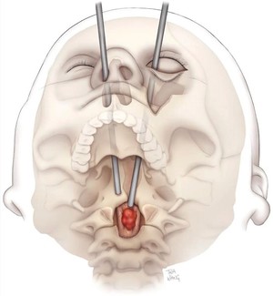 Intervenţie chirurgicală în premieră: tumoră spinală îndepărtată prin orbita oculară