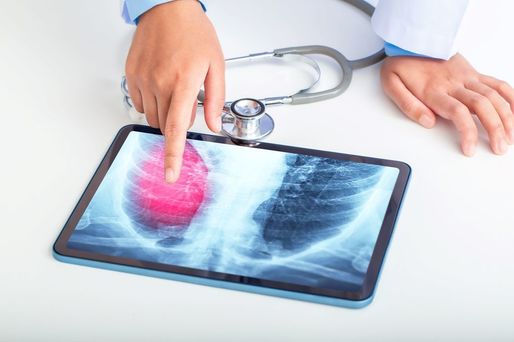 Rezultate promiţătoare pentru pacienţii cu cancer pulmonar avansat trataţi cu o terapie orală ţintită