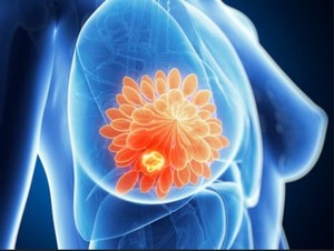 Un medicament experimental a eliminat cancerul de sân după o singură doză