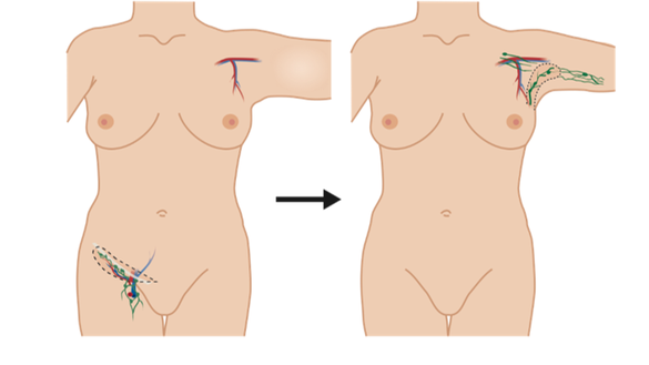 Transferul de ganglioni limfatici poate reduce riscul de limfedem după operaţia de cancer de sân, sugerează un studiu