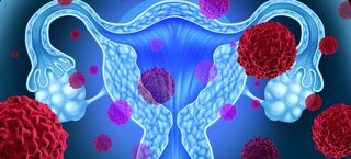 O proteină-cheie responsabilă de răspândirea cancerului ovarian, identificată de cercetători