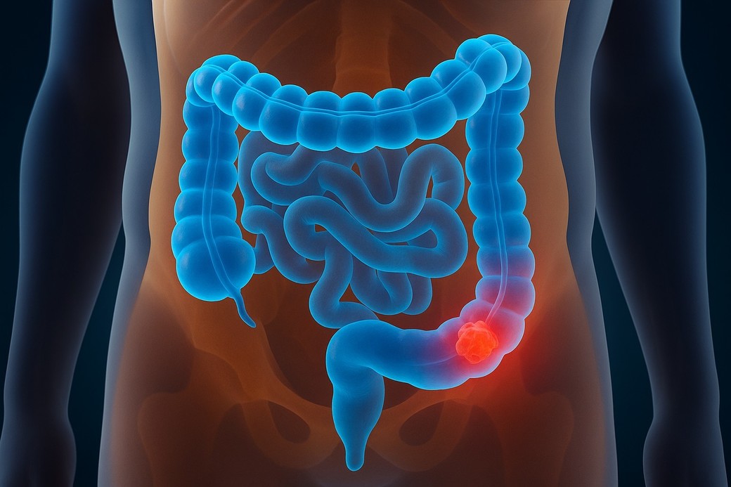 Cercetătorii au identificat o toxină bacteriană care ar putea explica incidenţa crescută a cancerului de colon la tineri