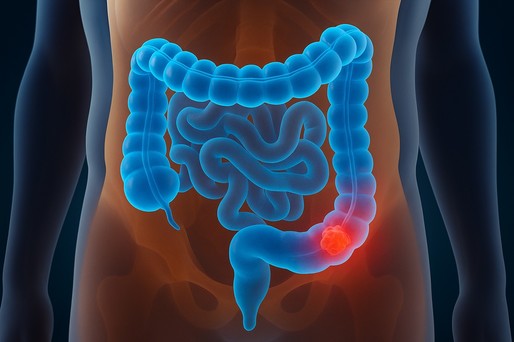 Cercetătorii au identificat o toxină bacteriană care ar putea explica incidenţa crescută a cancerului de colon la tineri