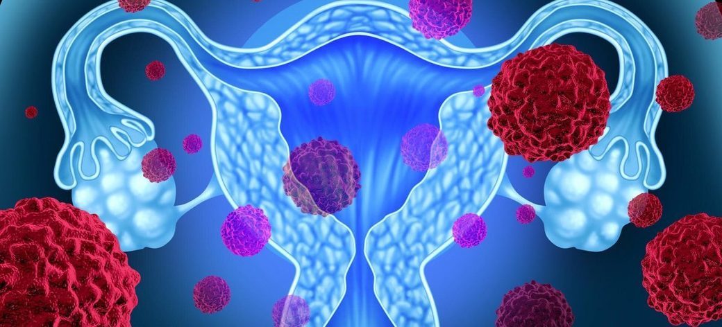 Noi soluţii inovatoare pentru depistarea precoce a cancerului ovarian