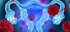 Noi soluţii inovatoare pentru depistarea precoce a cancerului ovarian