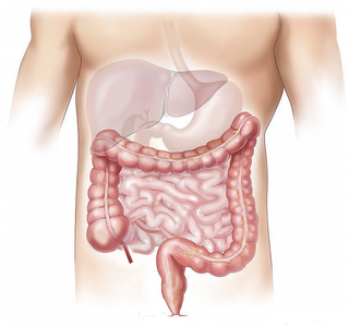 Un nou tratament pentru pacienţii cu cancer rectal obţine o rată înaltă de remisie completă