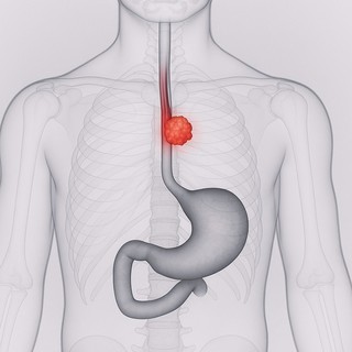 Imunoterapia administrată preoperator ar putea îmbunătăţi rezultatele pacienţilor cu cancer esofagian