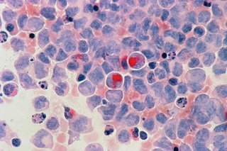O combinaţie de tratament a furnizat rezultate promiţătoare la pacienţii cu leucemie mieloidă acută cu un profil genetic specific