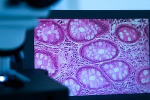Rezultate promiţătoare obţinute de un tratament inovator pentru leucemie fără chimioterapie