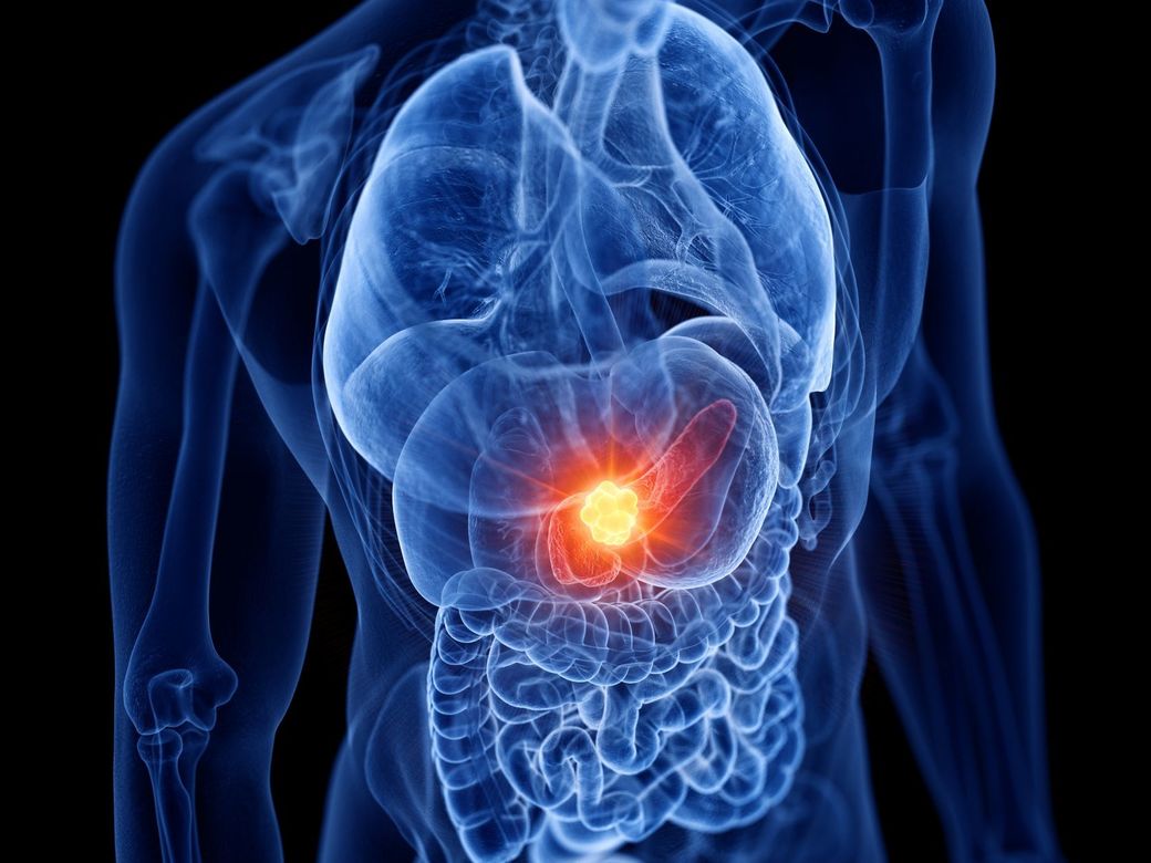 Semnătura genetică care anunţă din timp cel mai agresiv cancer pancreatic