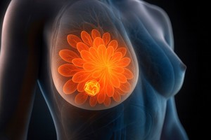 Un mecanism-cheie responsabil pentru rezistenţa la tratamentul cancerului de sân, identificat de cercetători