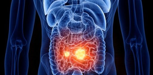 Descoperire-cheie privind interacţiunea dintre bacteriile intestinale şi cancerul colorectal