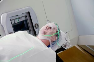 Abordare promiţătoare pentru protejarea creierului în timpul radioterapiei la pacienţii cu cancer cerebral 