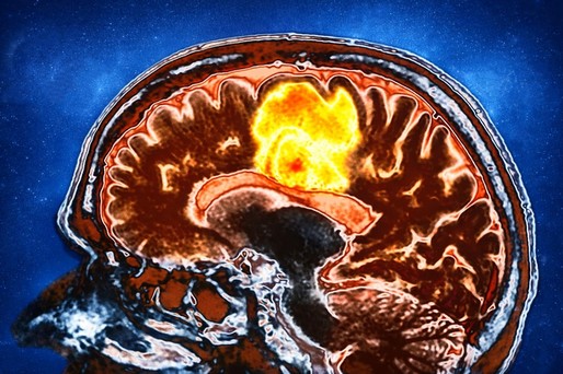Ar putea o combinaţie de nutraceutice să vindece una dintre cele mai letale forme de cancer cerebral?