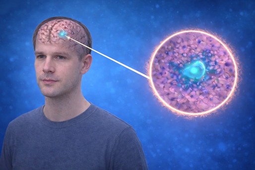 Celulele implicate în debutul unui tip frecvent de cancer cerebral, identificate de cercetători