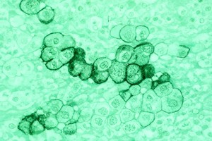 Un mecanism molecular implicat în agresivitatea cancerului pancreatic, identificat de oamenii de ştiinţă