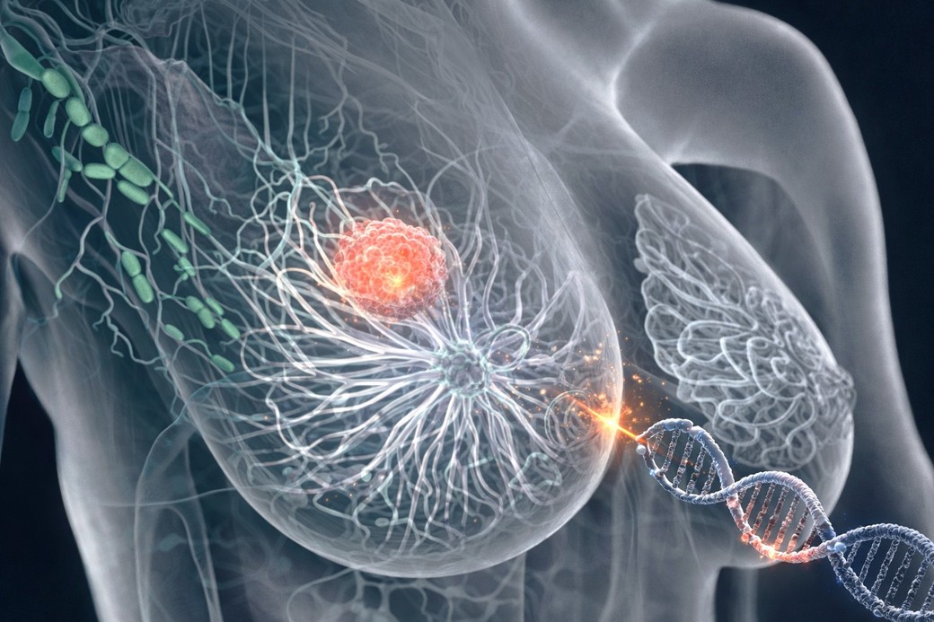 O bacterie implicată în boala parodontală, asociată cu apariţia şi răspândirea cancerului de sân