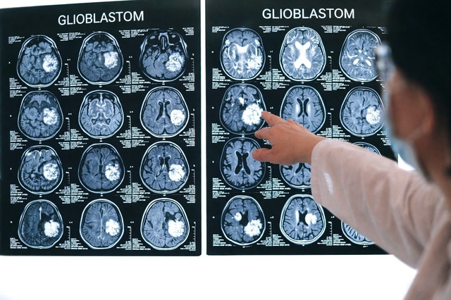 Cercetări de pionierat privind opţiuni de tratament pentru una dintre cele mai agresive forme de cancer cerebral
