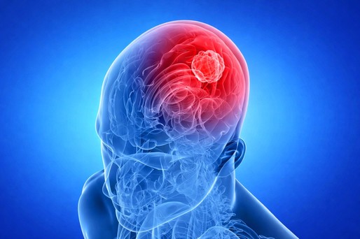 Strategie de tratament promiţătoare pentru glioblastom