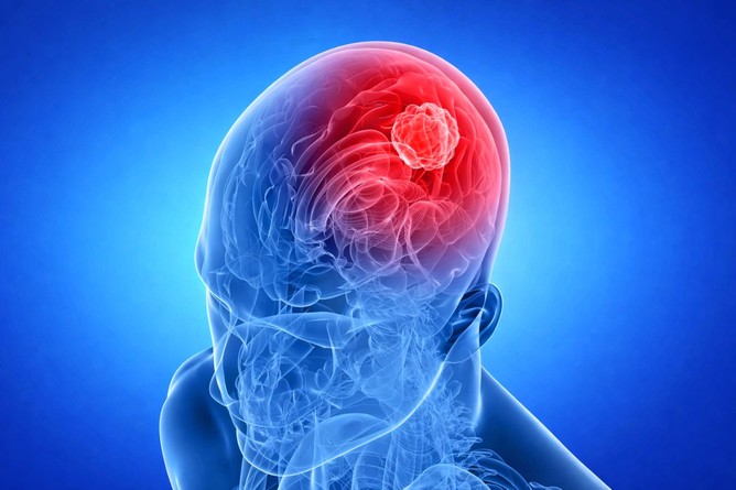 Strategie de tratament promiţătoare pentru glioblastom