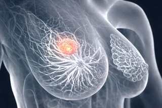 Agresivitatea cancerului de sân apărut după naştere, potenţiale explicaţii
