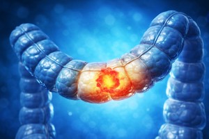 De ce creşte numărul cazurilor de cancer colorectal la adulţii sub 50 de ani. Cercetătorii oferă noi potenţiale explicaţii