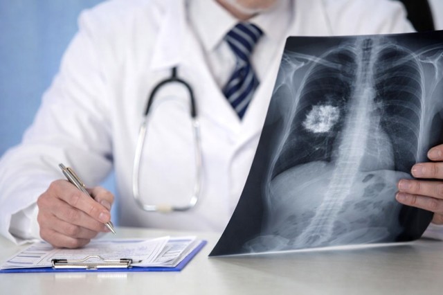 Poza pentru articolul Rezultatele unui studiu clinic care a evaluat dacă adăugarea imunoterapiei la tratamentul standard poate îmbunătăţi supravieţuirea în cancerul pulmonar cu celule mici