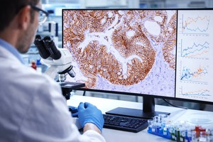 Un mecanism care favorizează metastazele hepatice în cancerul colorectal, identificat de cercetători