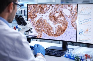 Un mecanism care favorizează metastazele hepatice în cancerul colorectal, identificat de cercetători